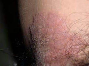 ���ƹ�Ѣ��ʲôҩ��