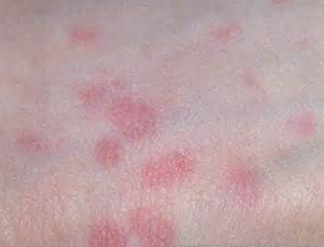 皮肤起红疙瘩瘙痒怎么办