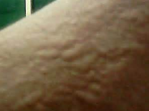 皮肤瘙痒起疙瘩怎么办