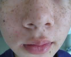 雀斑是怎么形成的