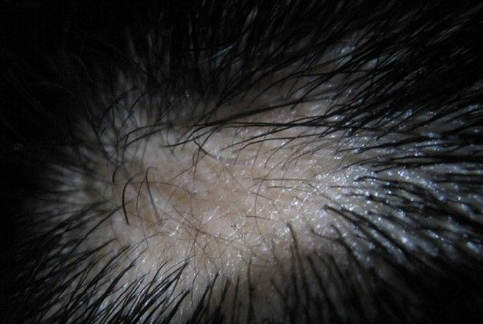 男性轻微斑秃怎么治疗