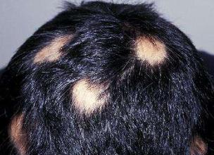 天津治疗斑秃方法是什么